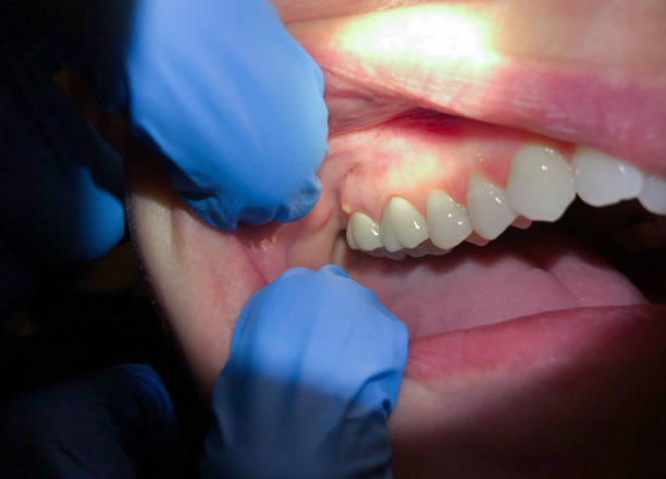 Best Emergency Treatment for Dental Infections or Abscesses in Fort Mohave, AZ